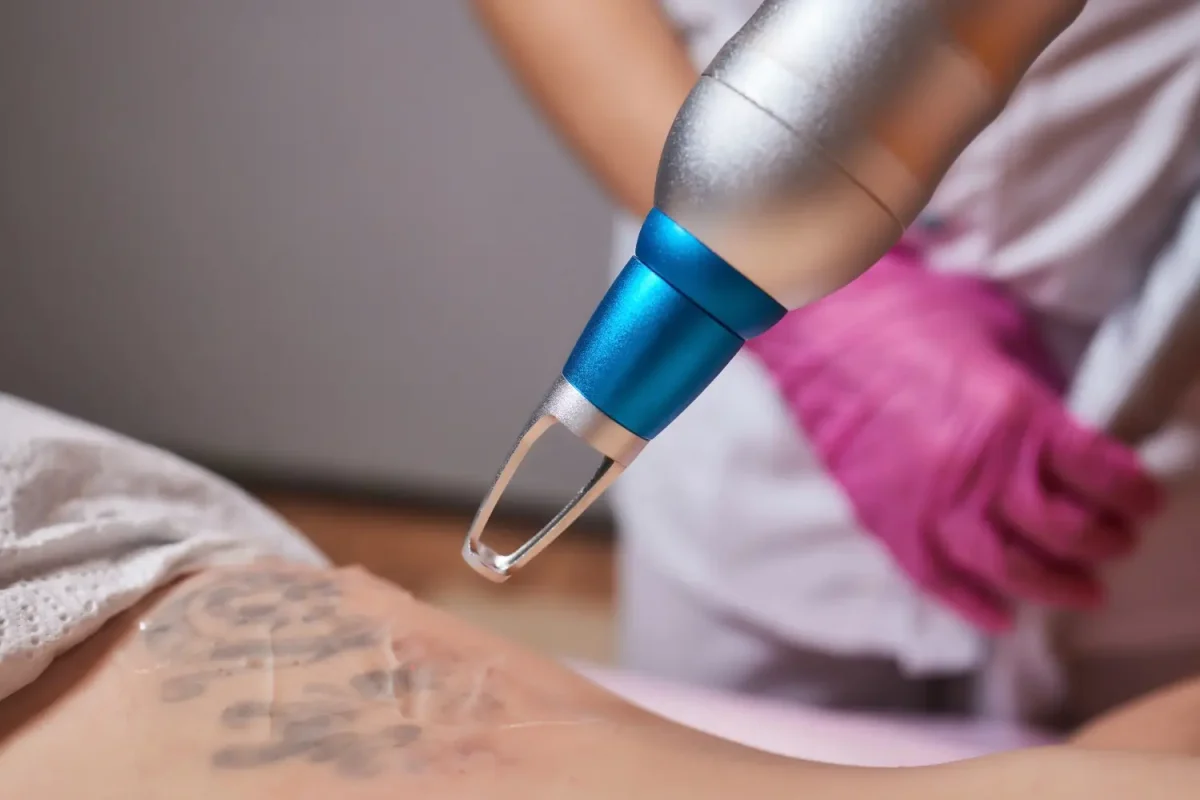young-woman-undergoing-laser-tattoo-removal-procedure-salon-closeup-1200x800.webp